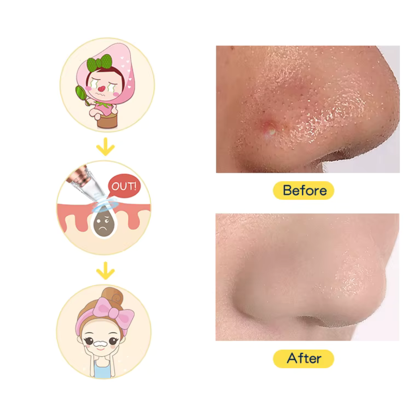 Aspirator Profesional pentru Puncte Negre –  Îndepărtare Acnee, Curățare Ten