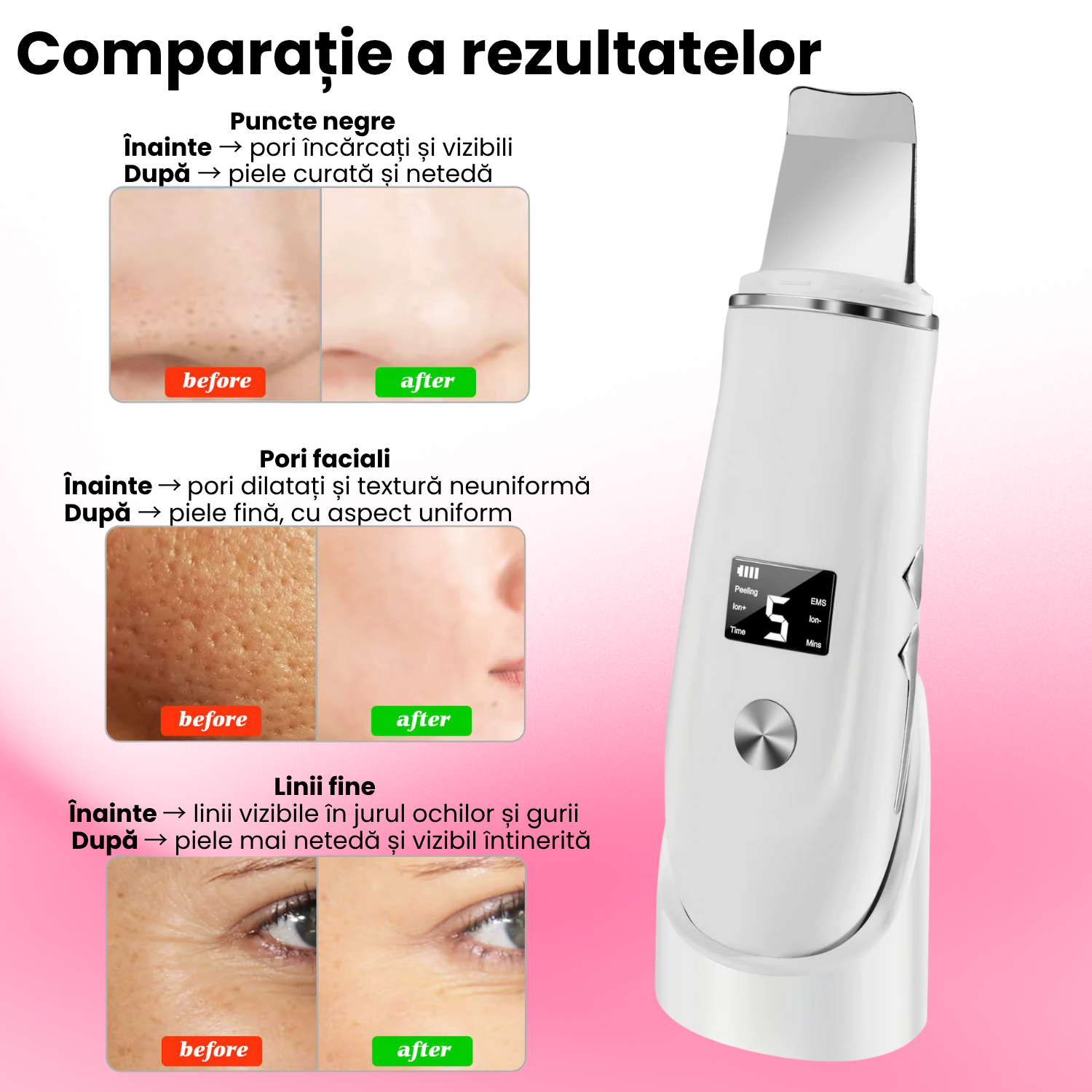 Scrubber Curatat piele Ultrasonic 4-in-1 TrustTech cu ionizare si EMS– Spatula Profesionala pentru Curatare Faciala